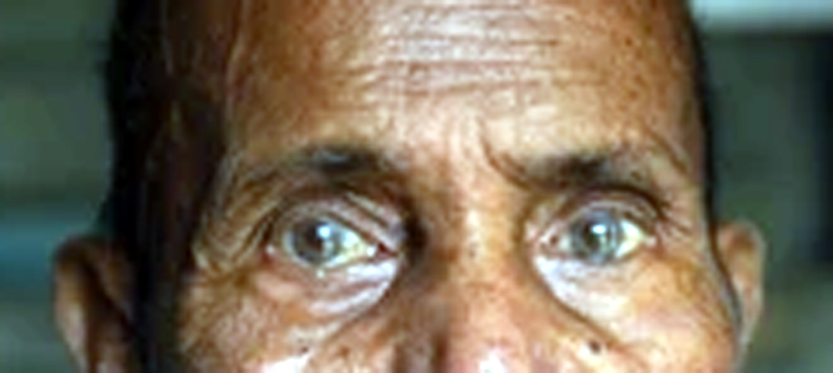 ಮೃತನ ಕಣ್ಣು ದಾನ ಮಾಡಿದ ಕುಟುಂಬದವರು